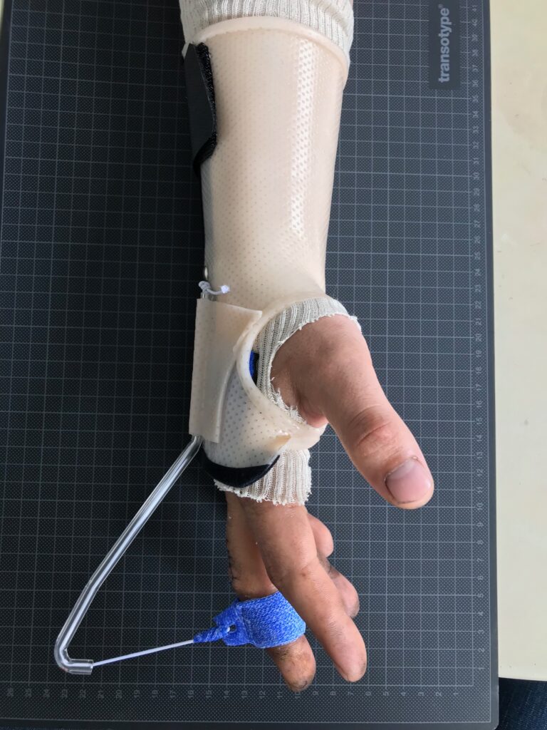Vue de dessus d'un avant-bras et d'une main portant une orthèse sur mesure beige perforée, avec un support bleu pour le majeur. L'orthèse, fixée par du velcro noir, est conçue pour la rééducation du poignet et des doigts, avec une tige métallique transparente reliant l'attelle au doigt sur un fond de tapis de coupe quadrillé gris foncé.