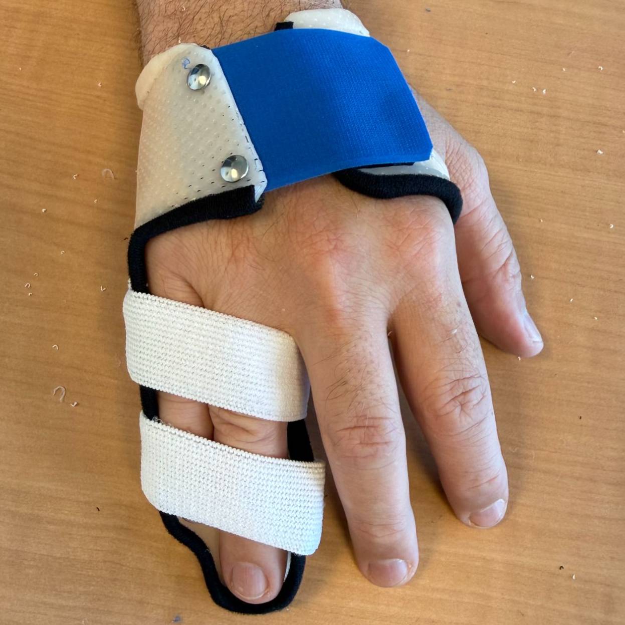 Orthèse sur-mesure blanche et bleue immobilisant le petit doigt d'une main, illustrant l'appareillage personnalisé pour une fracture de la phalange P1 du petit doigt.
