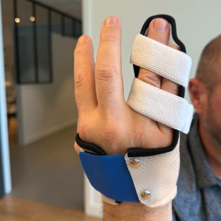Main d'un patient portant une orthèse sur-mesure blanche et bleue avec des sangles velcro pour immobiliser le petit doigt suite à une fracture de la phalange P1.