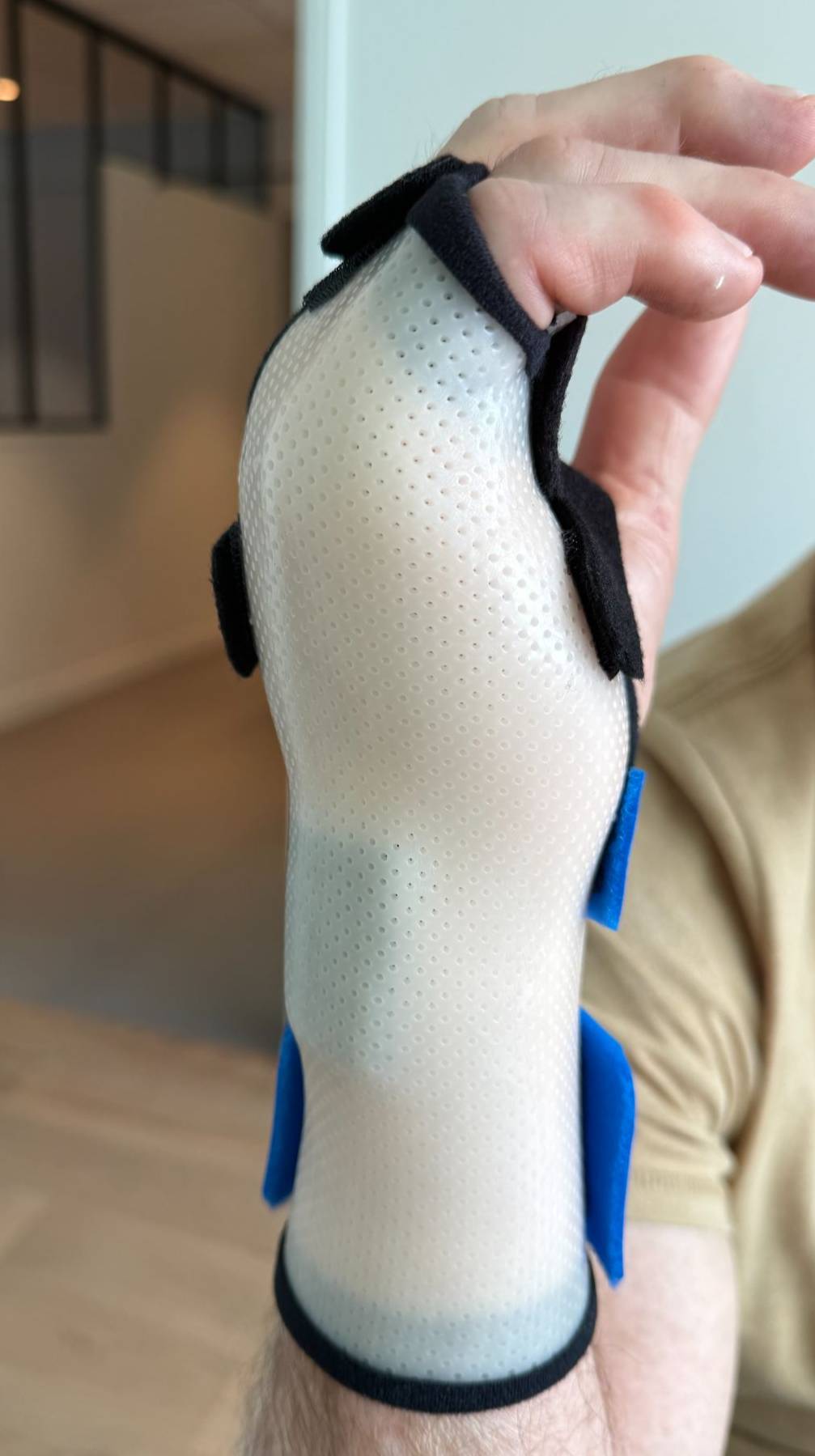 Main d'une personne portant une orthèse sur-mesure perforée pour immobiliser une fracture du boxeur (cinquième métacarpien)