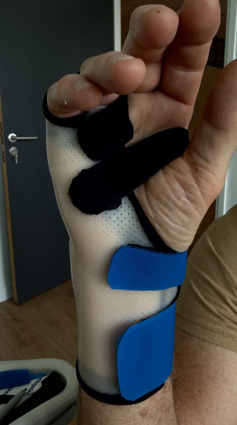 Orthèse sur-mesure blanche perforée avec sangles bleues et noires, immobilisant la main pour une fracture du boxeur.