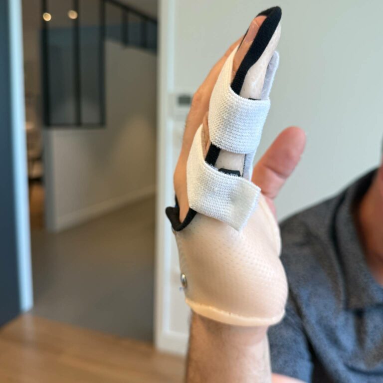Orthèse sur-mesure portée sur la main pour une fracture de la phalange P1 du petit doigt, vue de côté.