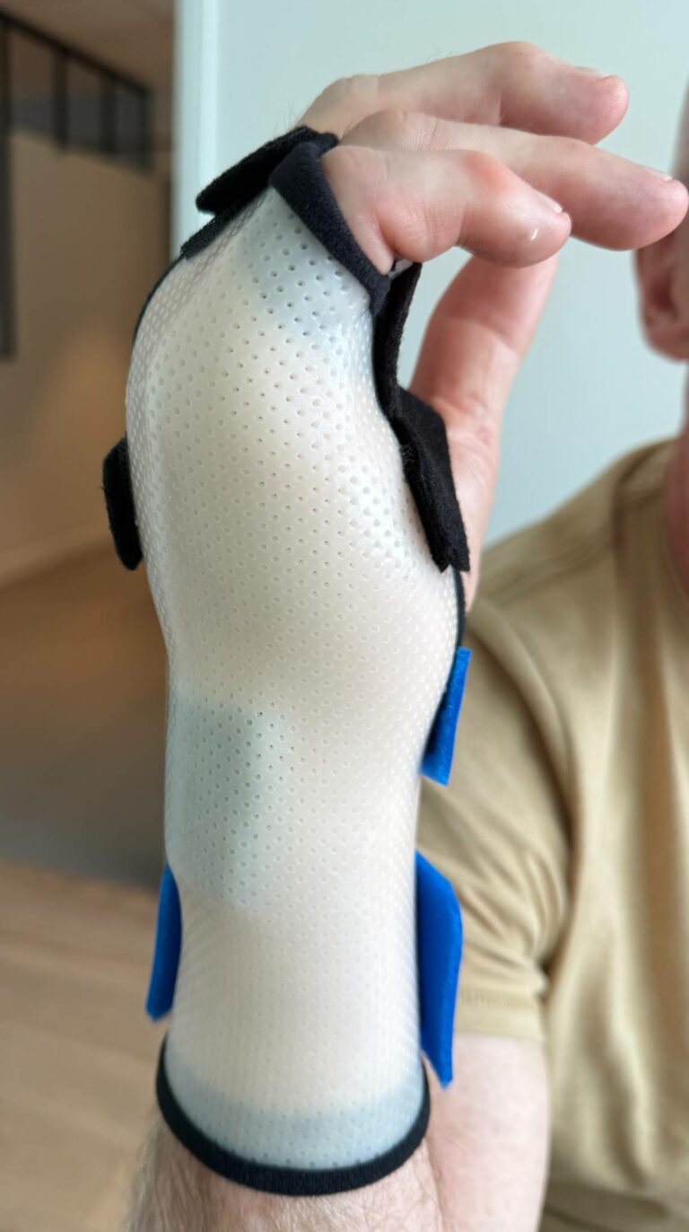 Orthèse sur-mesure perforée et légère immobilisant la main d'un patient après une fracture du boxeur.