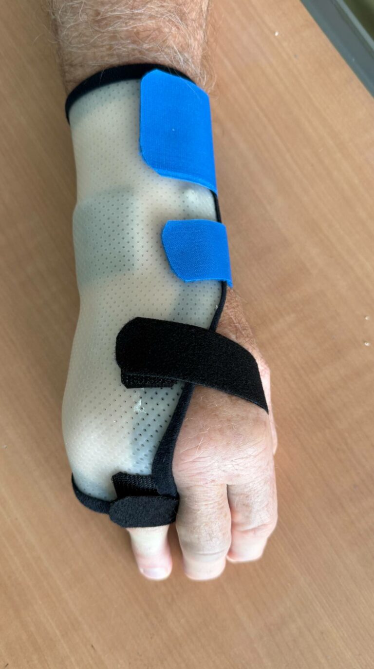 Orthèse sur-mesure claire et perforée portée sur la main droite d'un patient, avec des sangles bleues et noires, pour l'immobilisation du cinquième métacarpien suite à une fracture du boxeur.